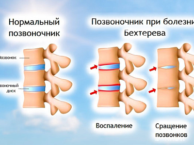 Что такое болезнь Бехтерева?